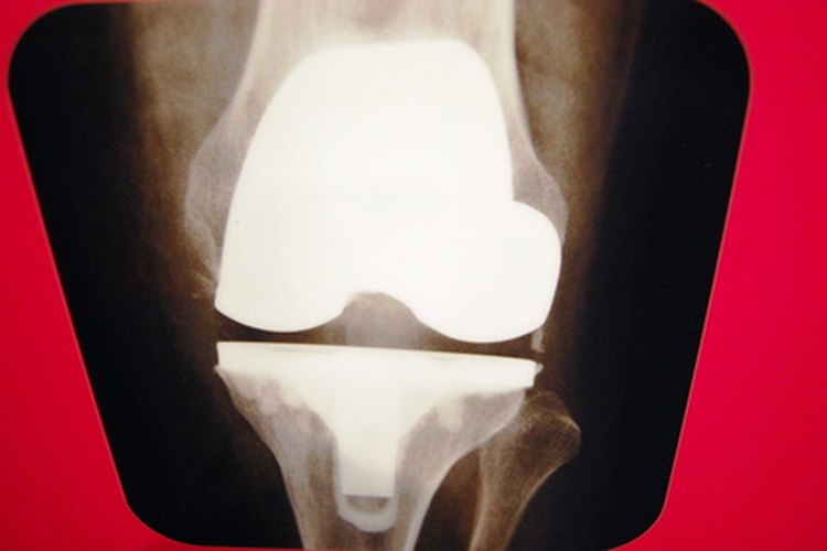 Lidiar con una rodilla hiperextendida.