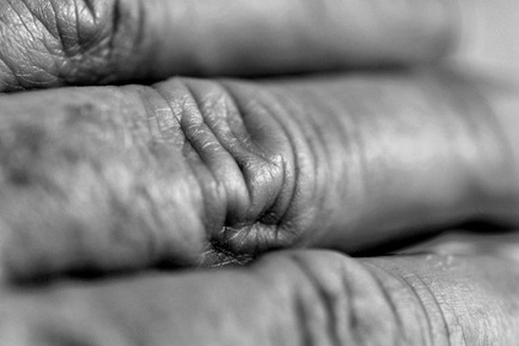 La artritis en los nudillos puede ser causada por muchas enfermedades diferentes.