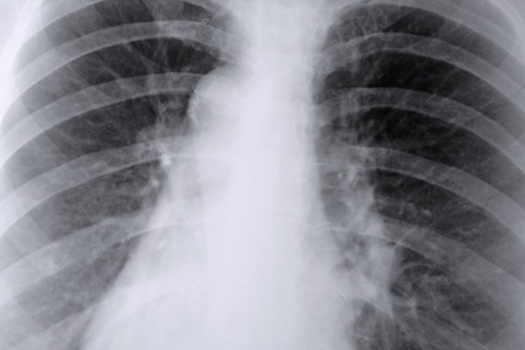 ¿Hongo pulmonar?