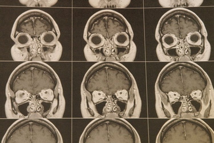 Los tumores malignos o cancerosos crecen muy rápidamente.