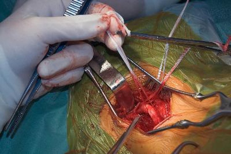 Las infecciones en hernias operadas pueden ser fácilmente tratadas la mayoría de las veces.
