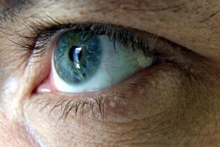 La iInflamación de la córnea puede crear distorsiones visuales.