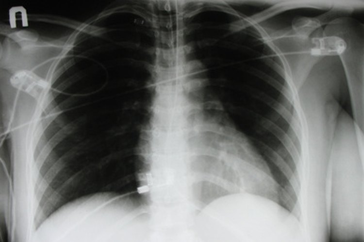 La tuberculosis (TB) es una infección bacteriana de los pulmones causada por el Mycobacterium tuberculosis.