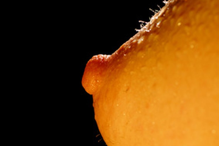 La presencia de un papiloma intraductal puede representar un riesgo de padecer cáncer.