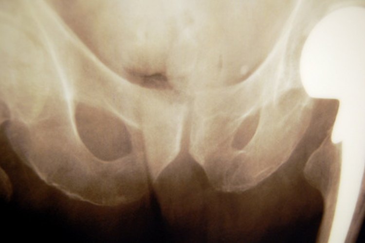 Aprende ejercicios para corregir la postura de tus caderas.