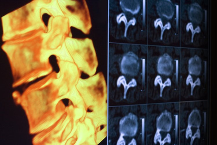 La vista lateral de la MRI puede revelar una diferencia en la distancia entre vértebras con una hernia de disco.