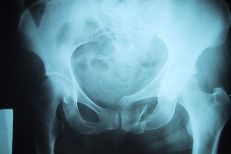Los ejercicios Kegel fortalecen los músculos del suelo pélvico.