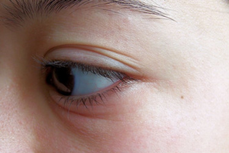 Ojos hinchados.