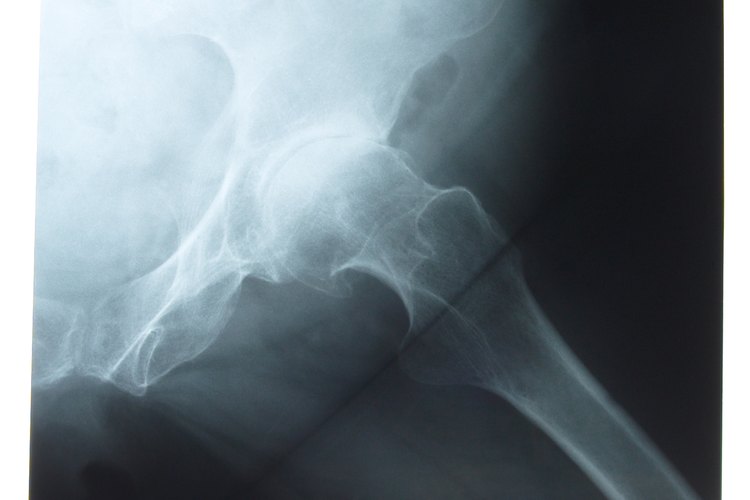 La osteoartritis de la cadera tiene hallazgos específicos en los rayos-X.