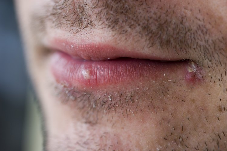 Un primer plano de ampollas en los labios de un hombre.