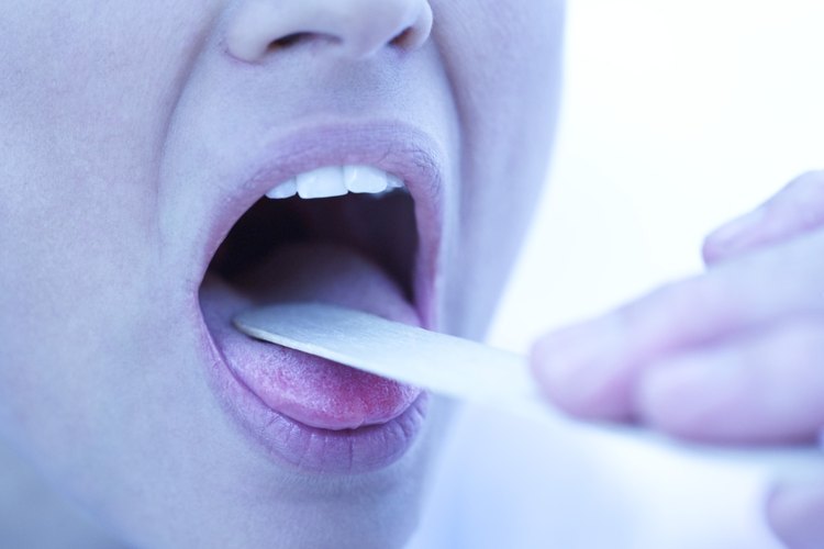Necesitas visitar a un médico o dentista para diagnosticar los cálculos amigdalinos.