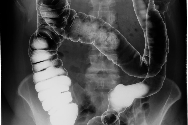 Una dieta blanda después de un ataque de diverticulitis puede ayudar a tu cuerpo a sanar.
