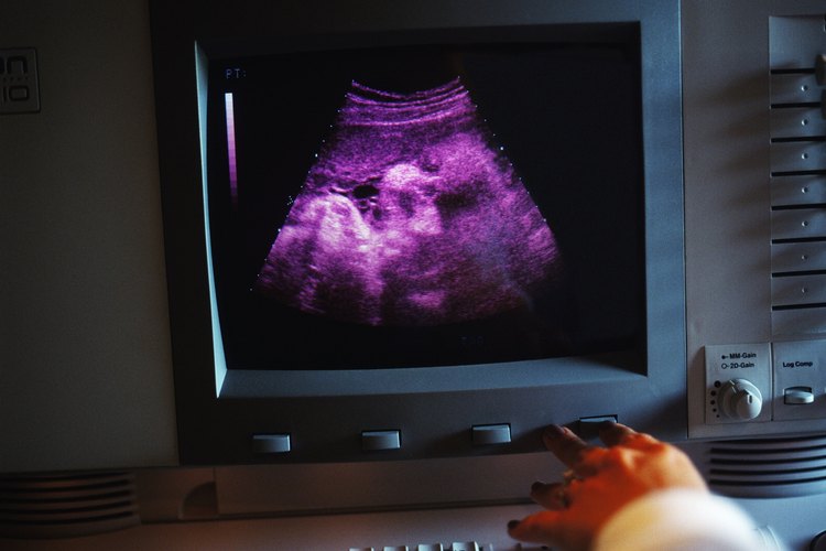 La ecografía fetal puede diagnosticar la ubicación y el tamaño de un hematoma subcorial.