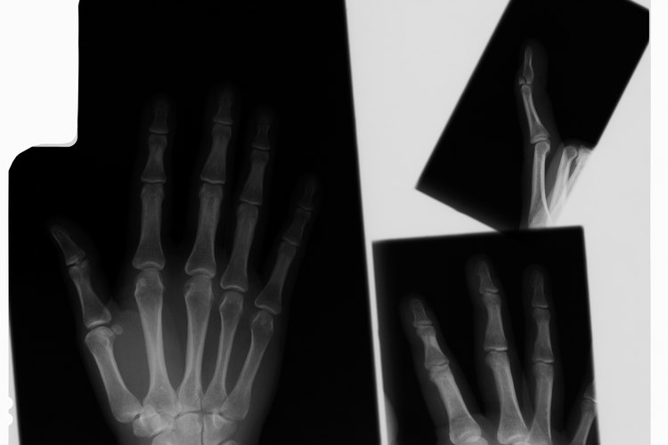 Los médicos utilizan férulas y yesos para el tratamiento de fracturas.