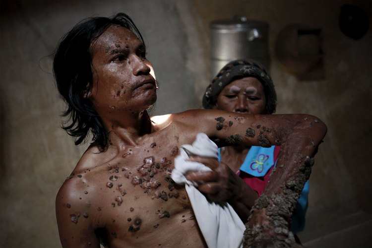 Las verrugas son crecimientos inofensivos en la piel producidas por el virus del papiloma humano.