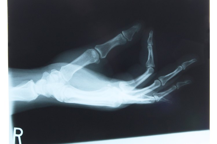 La tendinitis de Quervain produce dolor en la muñeca y se resuelve habitualmente con cirugía.