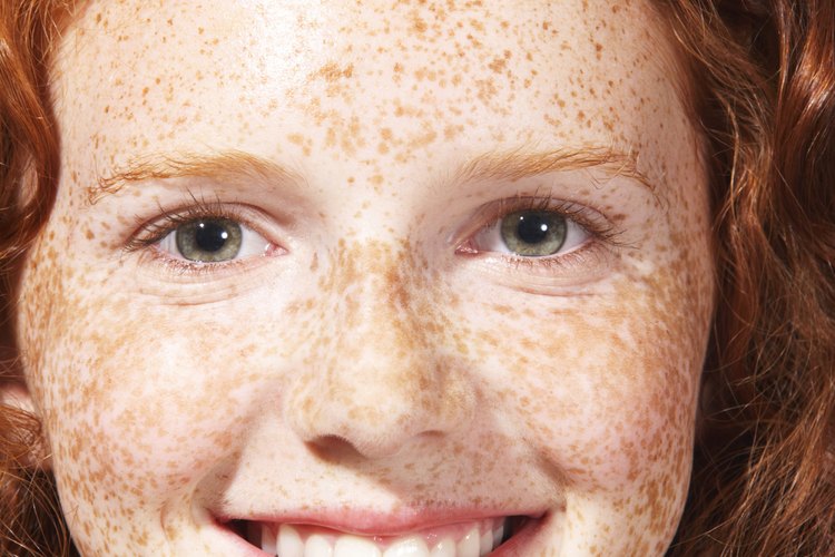 Las pecas pueden ser tan pequeñas como de un centímetro de diámetro.