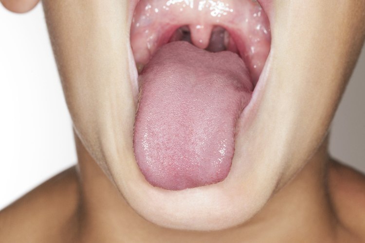 La glositis causa una pérdida de las papilas y una apariencia de suavidad en la lengua.