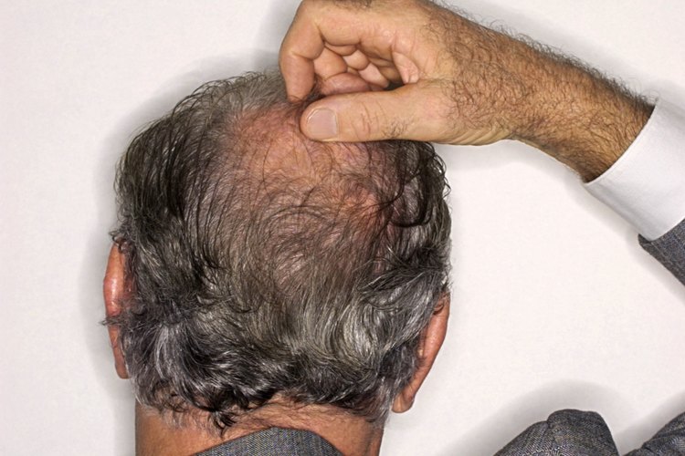 Alopecia en hombres.