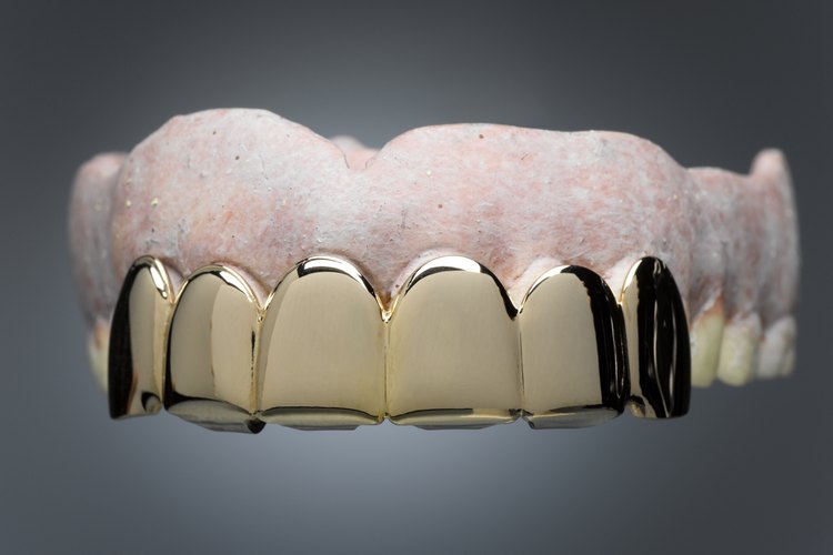 Aquí encontrarás cómo colocar una corona dental cuando no tienes acceso a un dentista.
