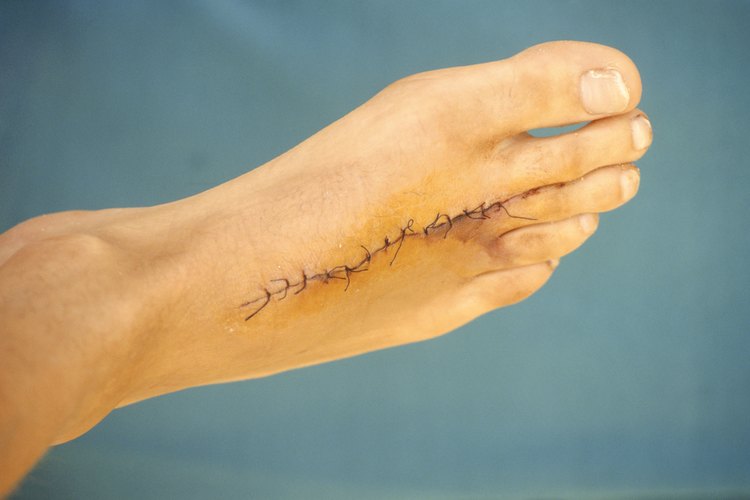 Las puntadas ayudan a sanar las heridas más rápido.