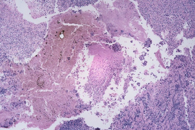 Cómo se transmite el cáncer de piel.