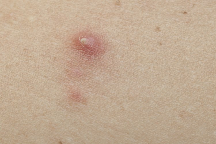 How To Use Tend Skin For Ingrown Hairs Leaftv