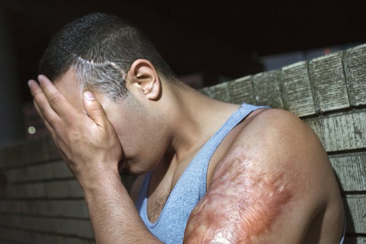 Los hematomas pueden aparecer en una de las extremidades después del ejercicio físico.