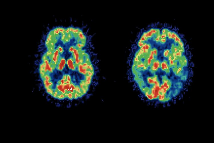 El cerebro se degenera de manera significativa en las etapas finales de la enfermedad.