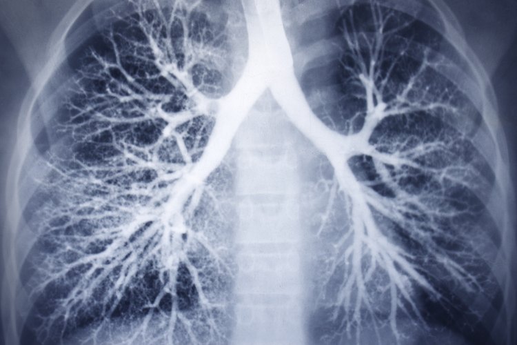 Los problemas de ventilación en los pulmones pueden llevar a bajos niveles de oxígeno en la sangre, específicamente si los alvéolos no funcionan correctamente.