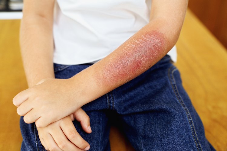 Si se trata de una herida pequeña, aplica crema antibiótica y cubre con una gasa o una venda antes de nadar.