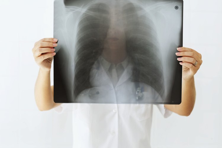 Las radiografías de tórax a veces ayudan a detectar el cáncer de pulmón.