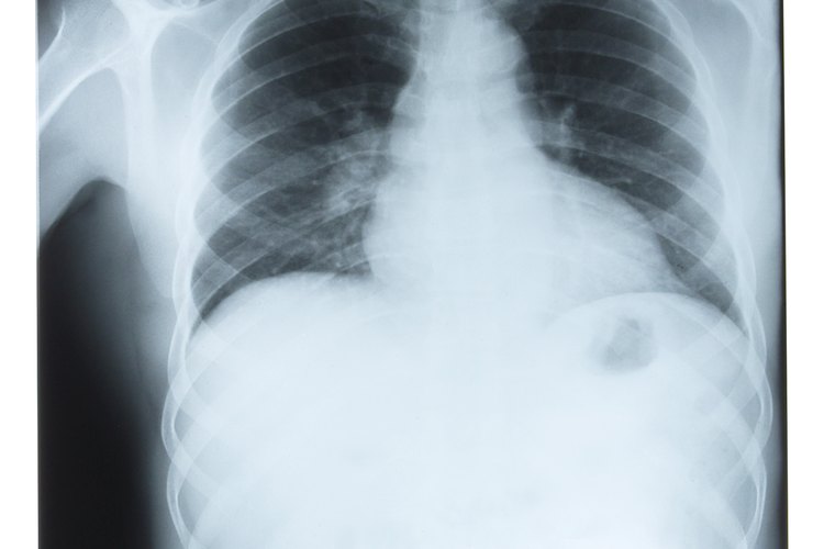 El cáncer de pulmón causa más muertes en el mundo que cualquier otro tipo de cáncer.