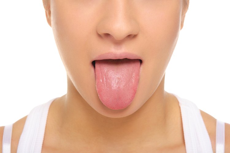 A taste bud becomes irritated and appears as a white or red bump on the tongue.