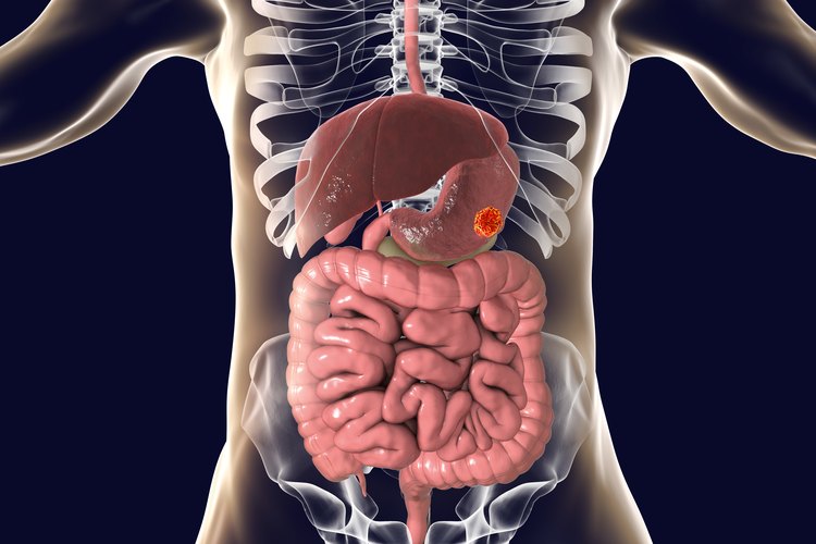 Cáncer Gástrico