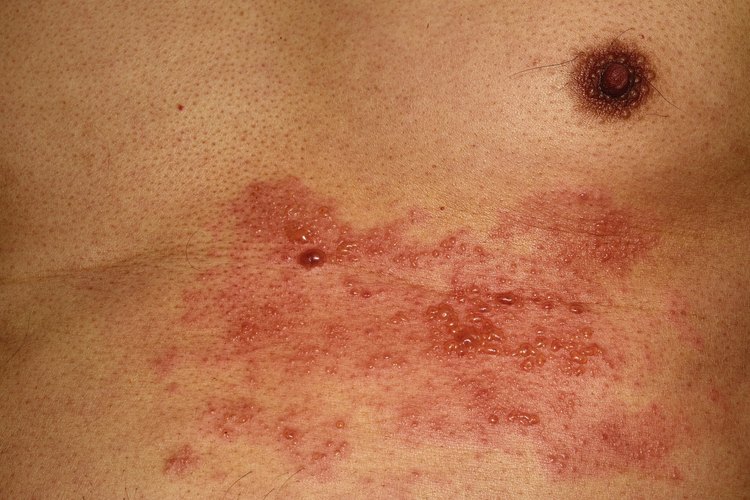 Culebrilla