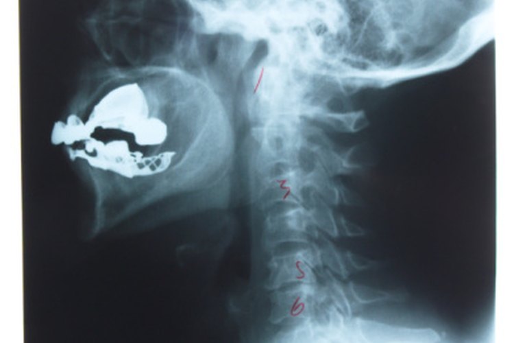 Los ejercicios de fortalecimiento pueden mejorar el funcionamiento de tu cuello después de una lesión.