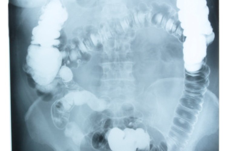 Una obstrucción intestinal se refiere a una obstrucción de algún tipo en tus intestinos.