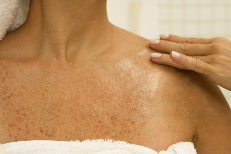 El aceite de vitamina E puede ser beneficioso para las manchas oscuras de la piel.