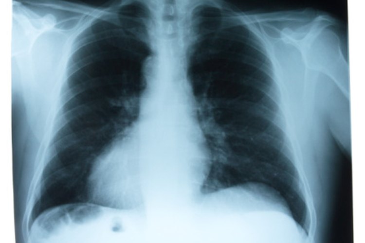 Una dieta saludable puede ayudar a reducir el líquido de los pulmones.