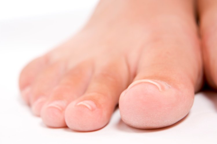 Las uñas de los pies curvas finalmente se encarnan.