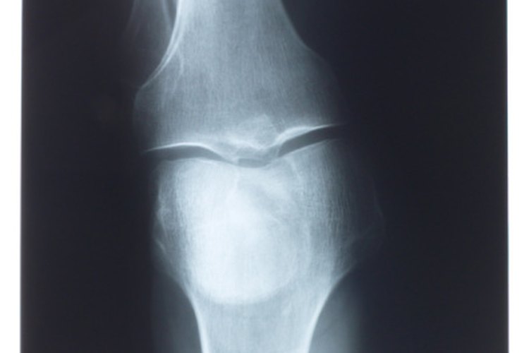 La osteoartritis a menudo se produce cuando las personas envejecen.