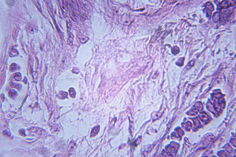 El cáncer de mama metastásico, también conocido como cáncer de mama grado IV, es la forma de cáncer de mama más avanzada.