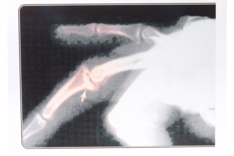 Evita esforzar demasiado los músculos de tus dedos y tu mano cuando entrenes con un dedo fracturado.