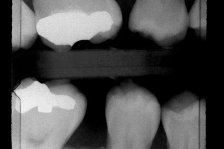 El blanco en la radiografía es un relleno, la caries en la radiografía se muestra como una sombra oscura en el diente.