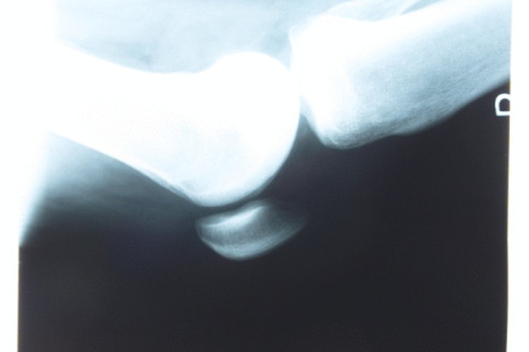 La vitamina B-12 puede ayudar a promover la cicatrización de los ligamentos desgarrados.