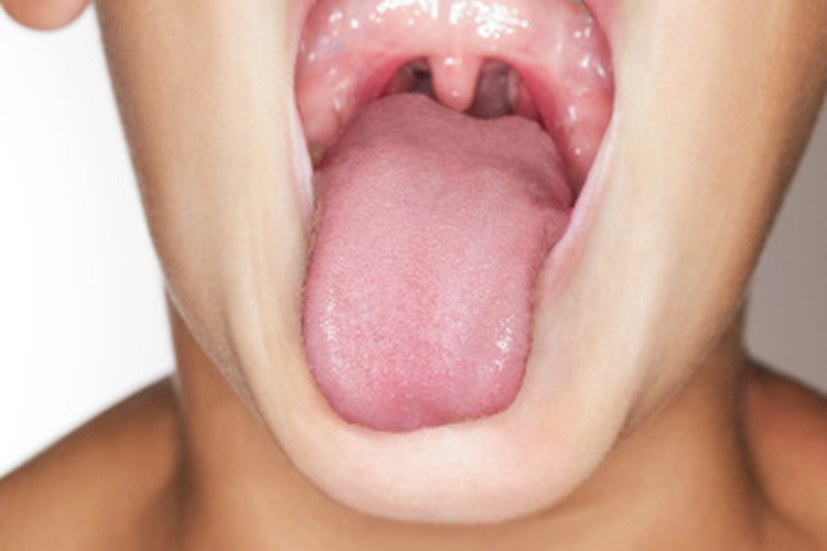 La candidiasis oral suele aparecer en la parte posterior de la garganta en forma de manchas blancas.