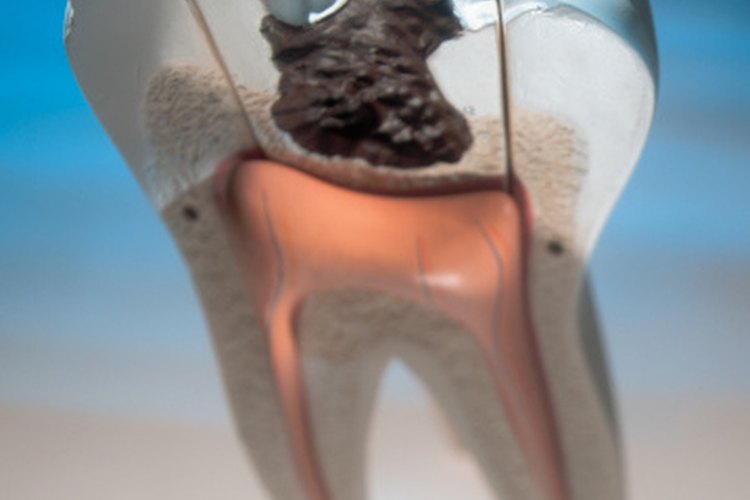 Los signos de un diente podrido deben convencerte de ver a un dentista.