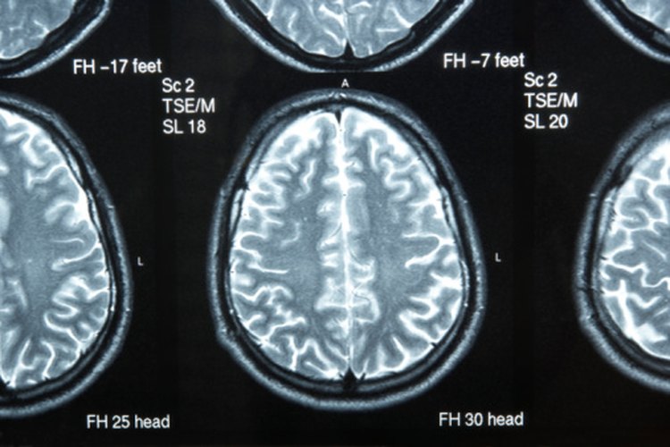 Brain cysts symptoms leaftv