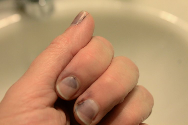 How To Get Rid Of Yellow Stains On Fingernails From Nail Polish